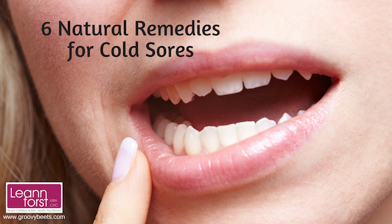 6 Natural Remedies for Cold Sores