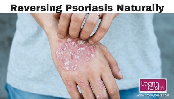 Reversing Psoriasis Naturally | GroovyBeets.com