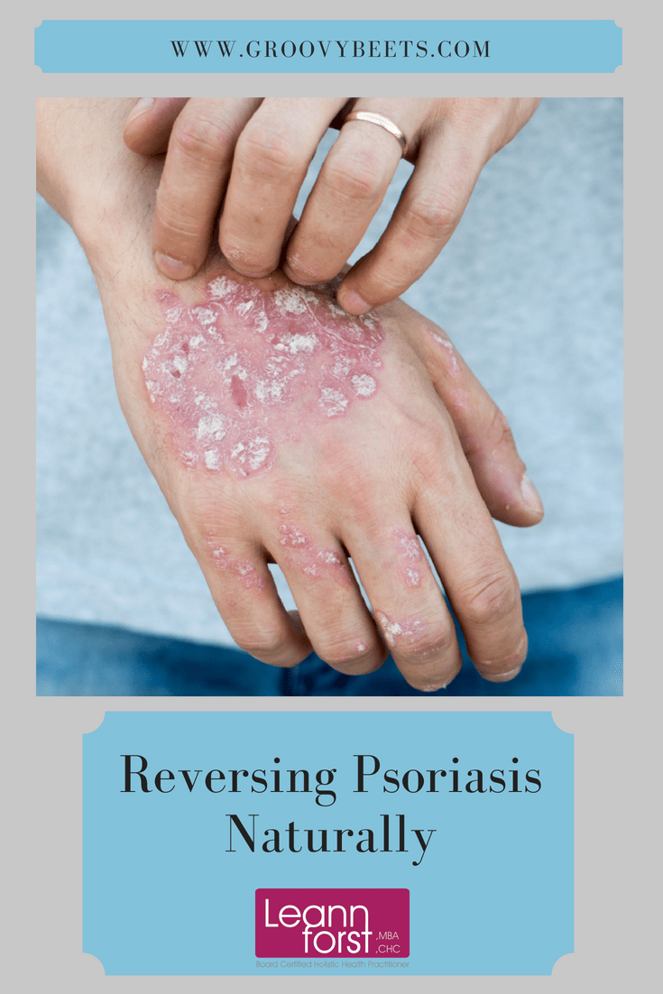 Reversing Psoriasis Naturally | GroovyBeets.com